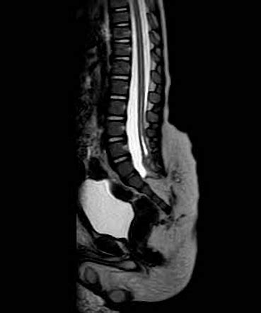 Lipomyelocele | Radiology Case | Radiopaedia.org