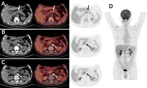 ¹⁸F-FDG PET/CT images of IgG4-RD; the mild increase of FDG uptake in ...