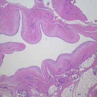 Microscopic Appearance Of The Excised Masses Revealing Fibrotic