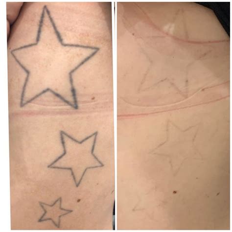 Các phương pháp laser tattoo removal an toàn và hiệu quả nhất hiện nay