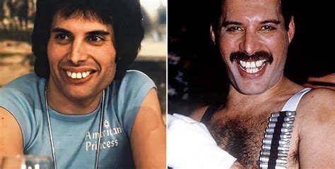 Freddie Mercury'S Teeth: An Iconic Smile - Lema Dental Clinic