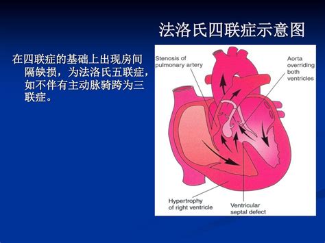 常见先天性心脏病 龙华医院肾内科 蔡小凡 Ppt Download