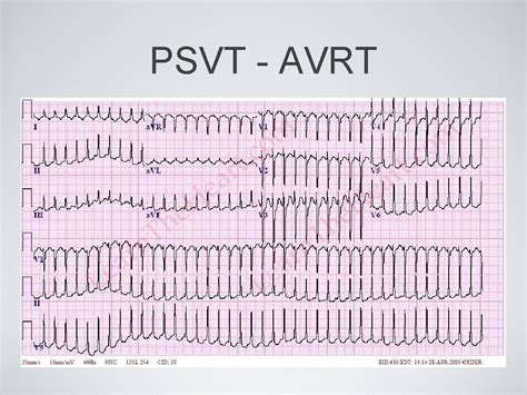 Recognizing Cardiac arrhythmias Normal anatomy Normal ECG Normal