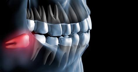 Sintomas Do Dentes Do Siso Nascendo Somos Popular Odontologia