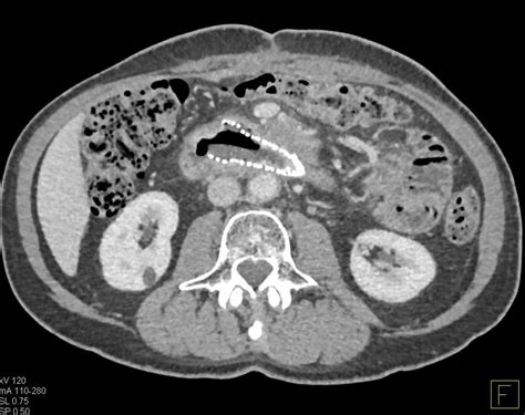 Pancreatic Cancer Invades The Duodenum With Endoluminal Stents