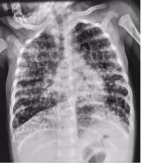 Miliary Tuberculosis With Severe Pneumonia Without Abnormal Chest