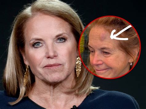 Katie Couric Debuts Nasty Forehead Bruise After Pickleball Accident