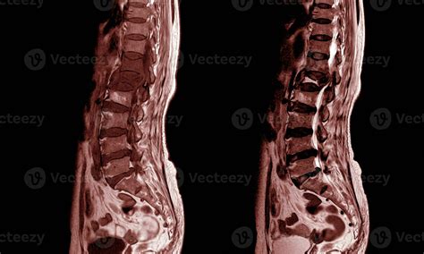 MRI OF THE LUMBOSACRAL SPINE. 26433999 Stock Photo at Vecteezy