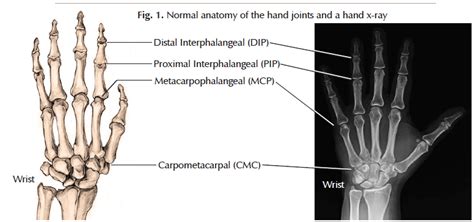 Hand Arthritis Hughston Health Alert Hughston Clinic