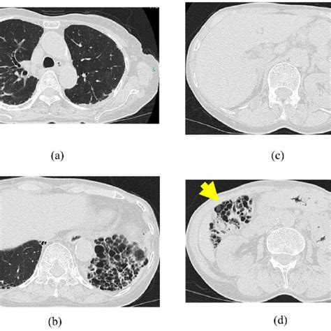 Chest Ct A Showing Nodular And Bronchiectatic Lesions In The Right