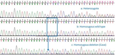 Chromatograms Demonstrating 4pb Sacs Deletion Sanger Sequencing Traces