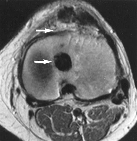 MR Imaging Of Cyclops Lesions AJR