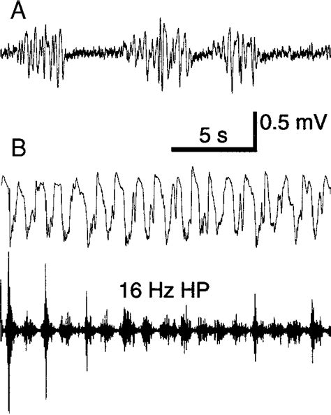 Normal Eeg Patterns