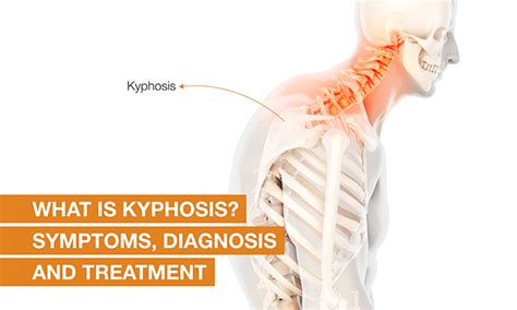 What Is Kyphosis Types Symptoms Causes And Treatment Qi Spine