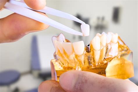 Can Dental Implants Replace Multiple Teeth Relax And Smile Dental