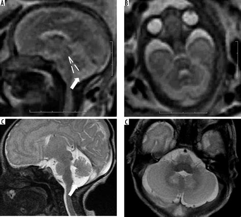 Imaging Spectrum Of Posterior Fossa Anomalies On Foetal Magnetic