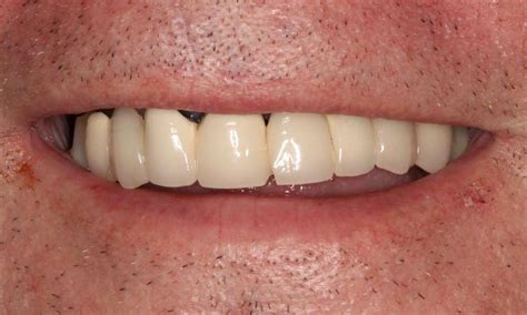 Implant Dentures Before After Photos Brentwood Tn