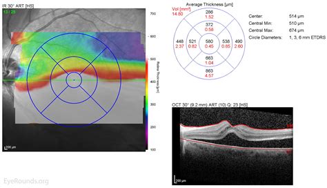 Tractional Retinal Detachment Oct