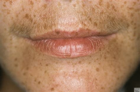 Black People and Freckles | New Health Advisor