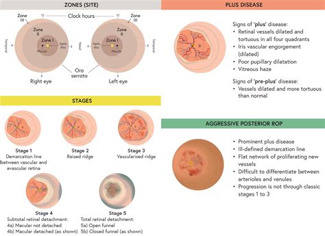 Retinopathy Of Prematurity Rop Ophtha Info