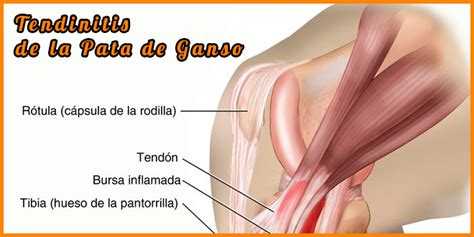 Tendinitis Pata De Ganso Causa S Ntomas Y Tratamiento Para Ello