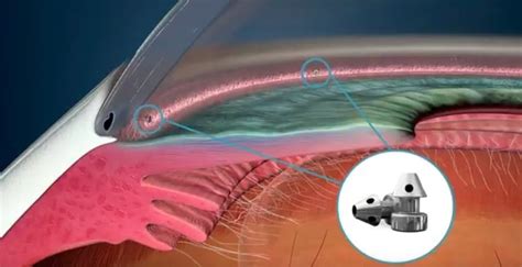 Minimally Invasive Glaucoma Surgery Central Valley Eye Medical Group