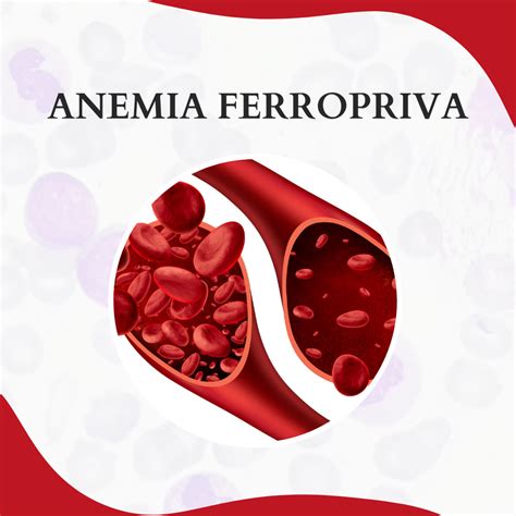 Anemia Ferropriva Import Ncia Cl Nica Atlas Em Hematologia