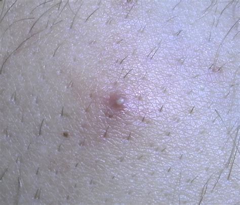 Ingrown Hair Vs Herpes