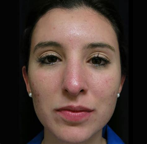 Patient 122908673 Nasal Fracture Before And After Photos Lampert Md