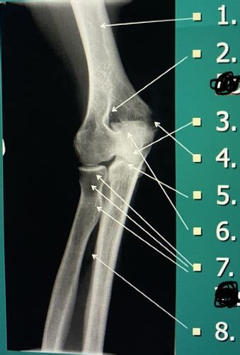 External Oblique Elbow Flashcards Quizlet