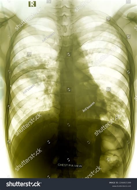 Chest Xray Pa View Show Suggestive Stock Photo Shutterstock