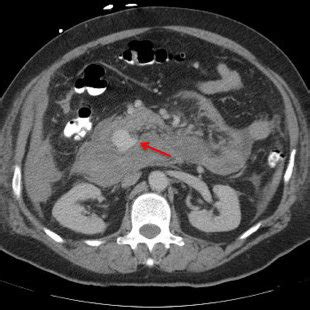 Abdominal Contrast Enhanced Computed Tomography Reveals Retroperitoneal