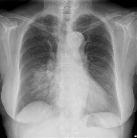 Right Middle Lobe Consolidation Radiology Reference Article