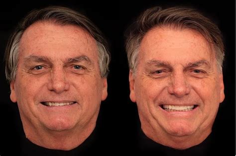 Bolsonaro Coloca Lentes De Contato Nos Dentes Vaidade Não Faz Mal A