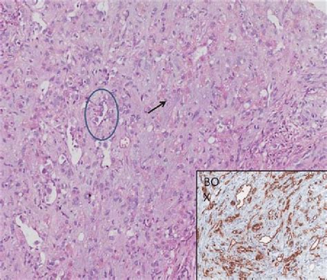 Neoplastic Spindle And Epithelioid Cells Infiltrating The Sinusoidal