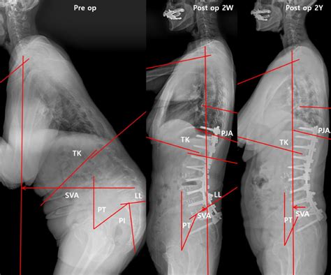 Effect Of Overcorrection On Proximal Junctional Kyphosis In Adult