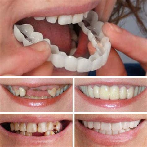 Types Of Snap In Dentures Merypizza