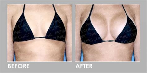 Off Lipofill Breast Enlargement Premier Clinic