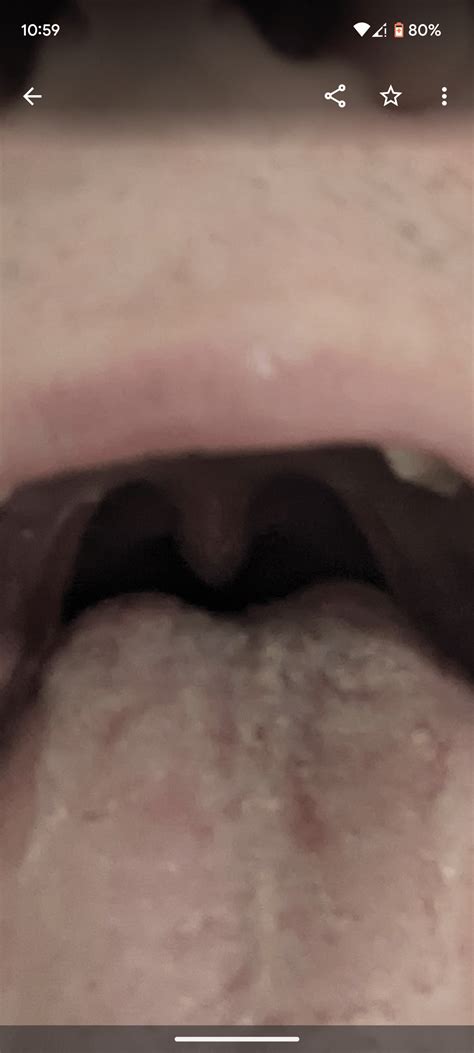 What are these pimples on my tongue? : r/pimplecommunity