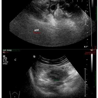 Ultrasound findings for appendicitis diagnoses. | Download Scientific ...