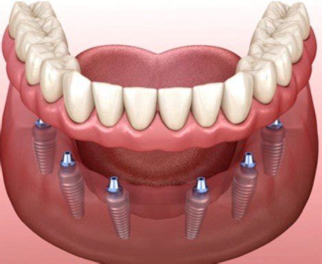 Implant Retained Dentures Richmond Hill Smile Centre We Customize