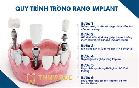 Trồng Răng Implant Có đau Không Cách Giảm đau Khi Trồng Răng