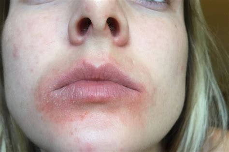 Skin Rash Around Mouth