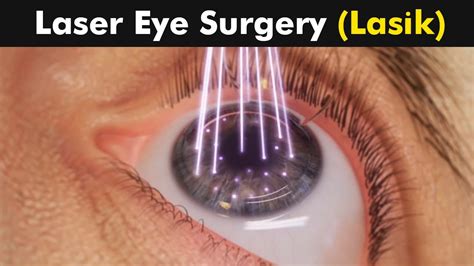 How Laser Eye Surgery (Lasik) is Performed? | 3D Animation (Urdu/Hindi ...