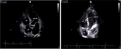 A Post Hbp Implant Transthoracic Echocardiogram Showing The Hbp Lead