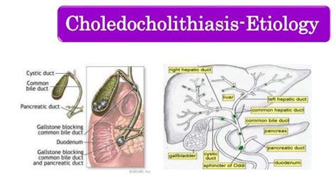 Choledocholithiasis Obstructive Jaundice