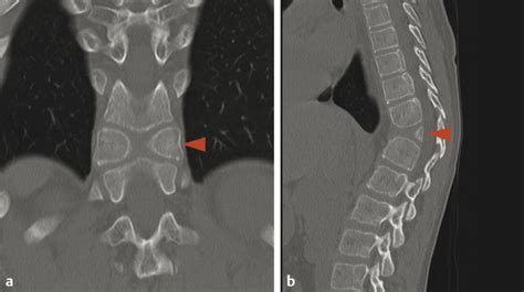 Lumbar Spine Xray Abnormal