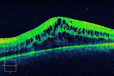 Macular Edema - Eye Life Vision Center