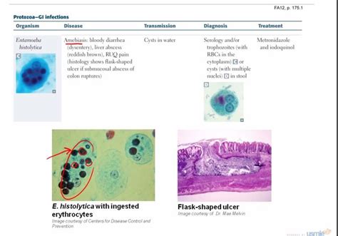 Entamoeba Histolytica Flask Shaped Ulcers