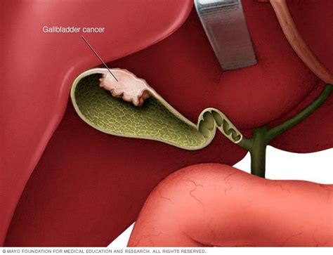 Gallbladder cancer Disease Reference Guide - Drugs.com